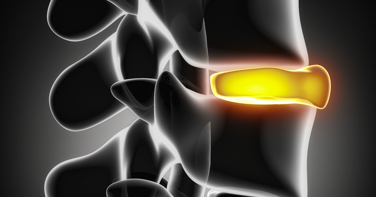 Illustration of a highlighted spinal disc ruptured in x-ray view