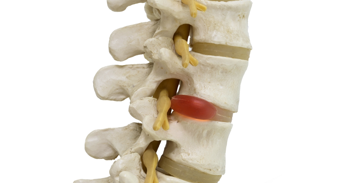 Close-up view of herniated lumbar vertebral disc m